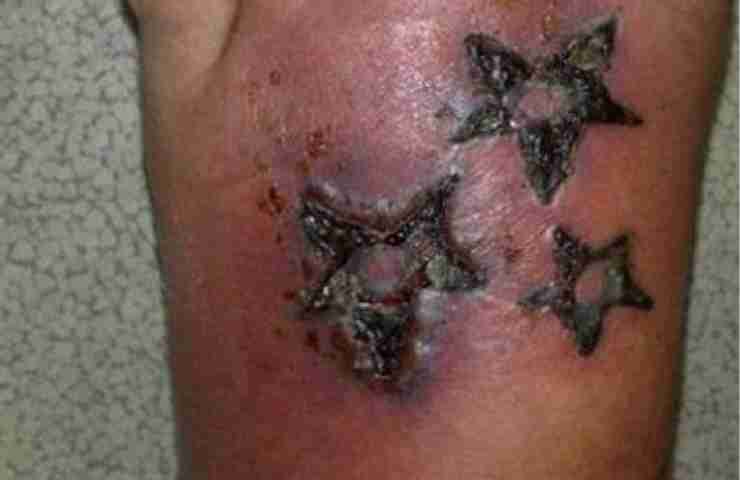 Tatuaggi infezione piede
