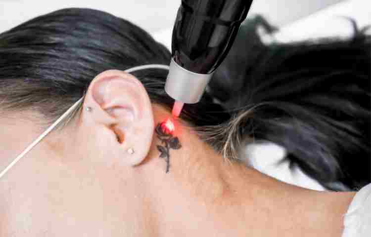 tatuaggi rimozione laser
